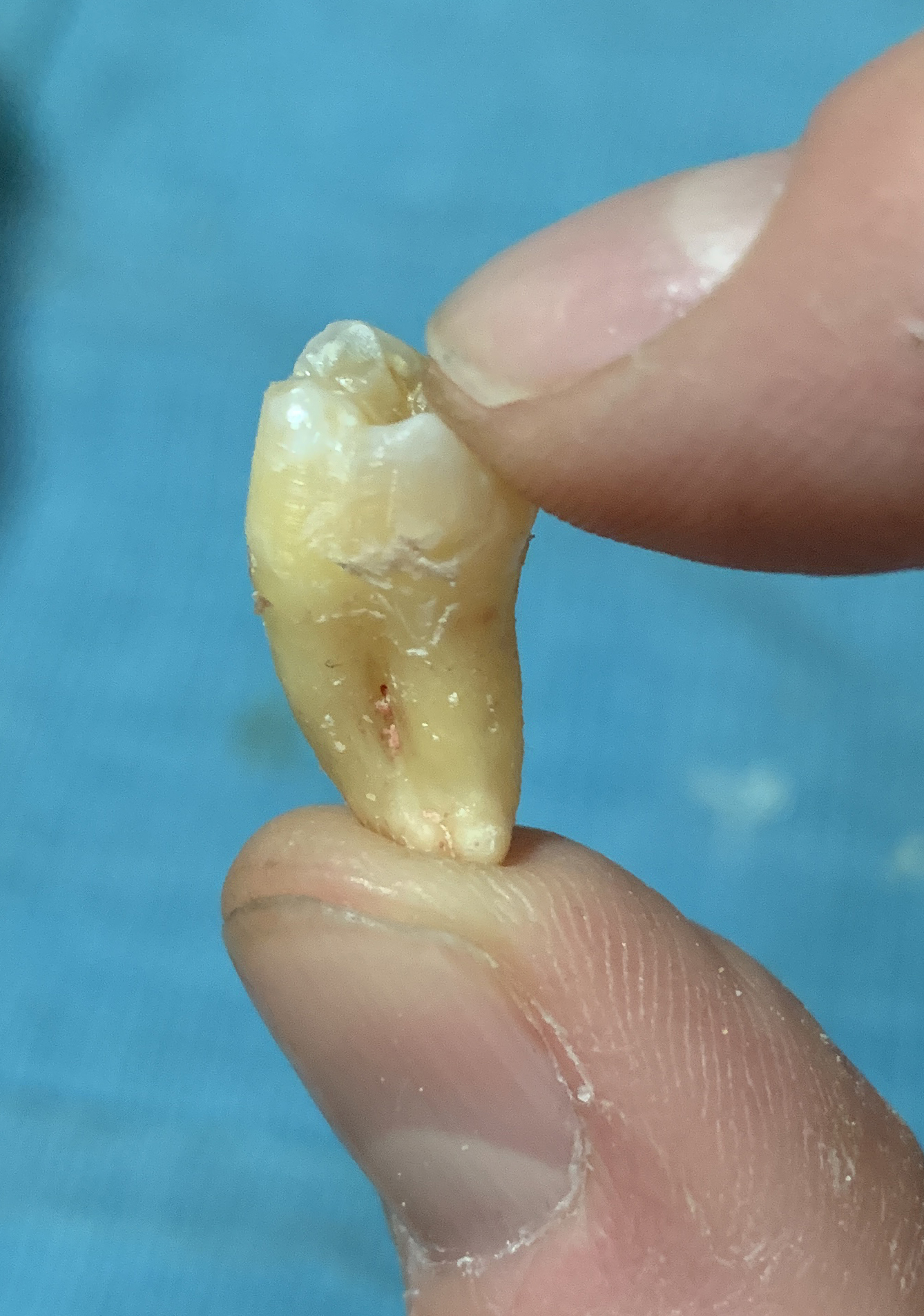 streetsblog editor's tooth