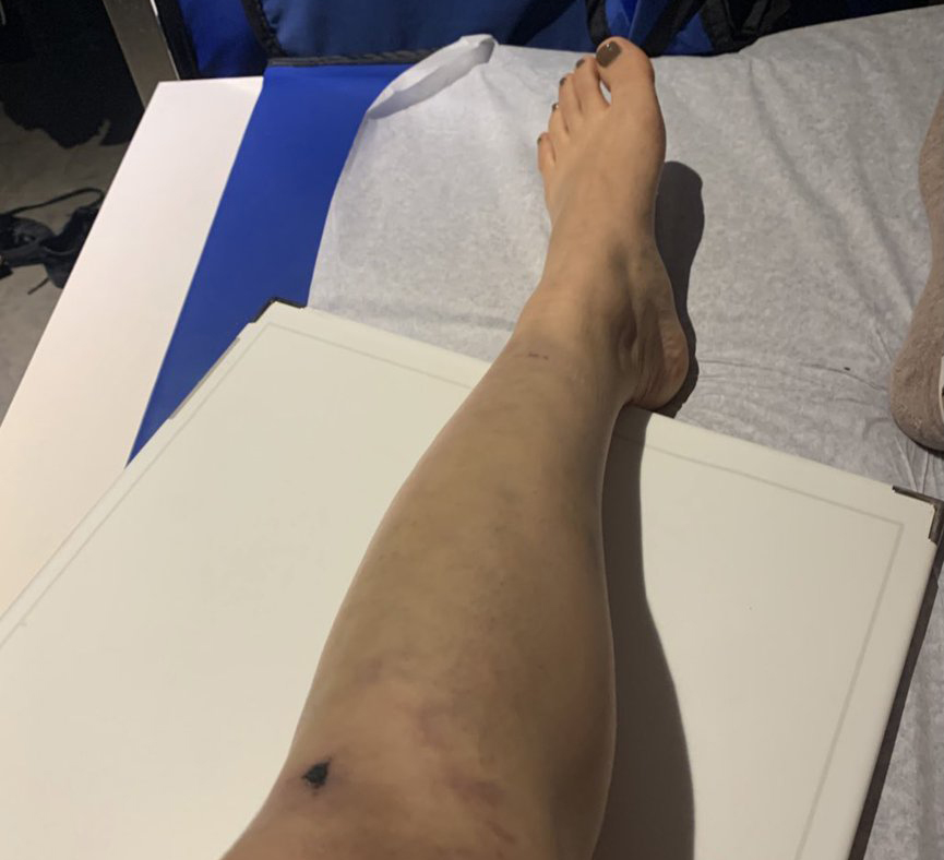 Queens City Council Candidate Run Down and Injured by Driver